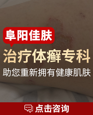 阜阳治疗牛皮癣医院