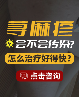 阜阳治疗湿疹医院