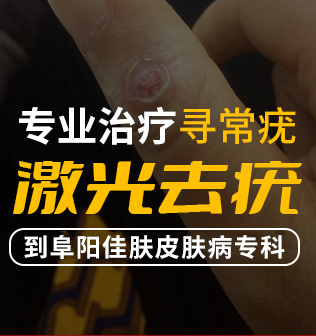 阜阳治疗扁平疣医院