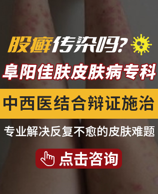 阜阳治疗灰指甲医院